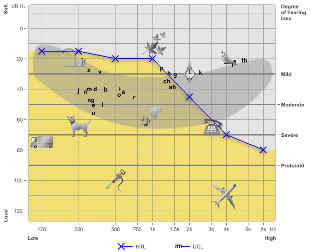 Sky-slope-hearing-loss-type